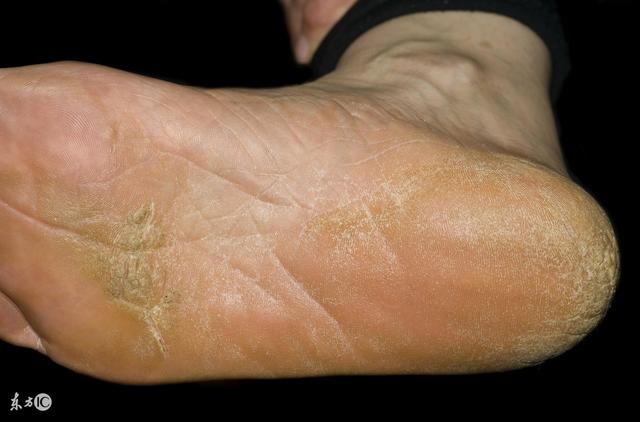 香港脚是什么意思香港脚的由来