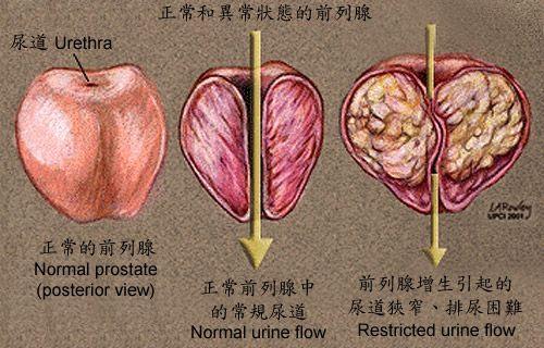 前列腺什么意思(前列腺是什么部位)