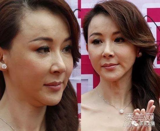 7大女明星整容失败越变越丑 萧蔷脸肿嘴歪 巩新亮成“僵尸新娘”