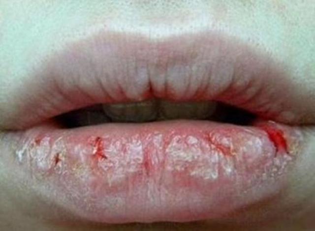 嘴唇是健康的“信灯号”，6种嘴唇标志，暗示6种身体问题，别大意