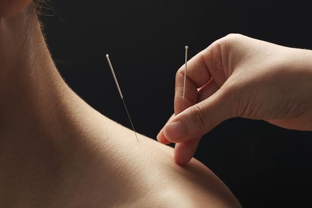 针灸的流程(针灸流程及规范)