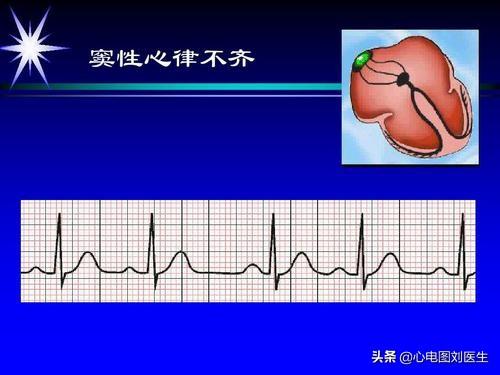 窦性心律不齐是什么意思(窦性心律不齐要紧吗)