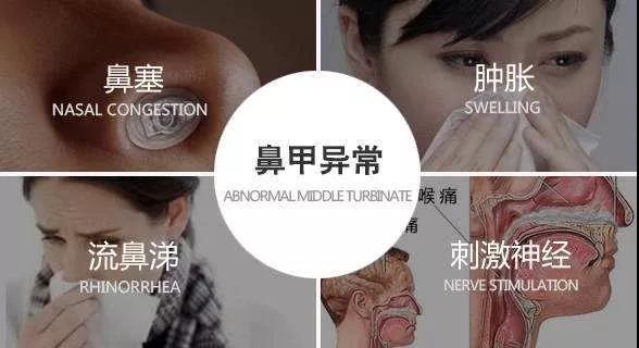 鼻甲肥大是什么意思鼻甲肥大必须手术吗