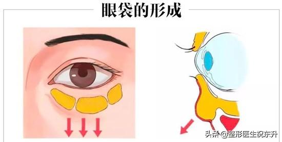 体验日记|被"眼袋、泪沟"拖累了颜值，我是这样逆袭的