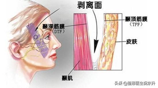 拉皮手术后，脸上的皱纹、松垂不见了，为什么连皮肤也变好了？