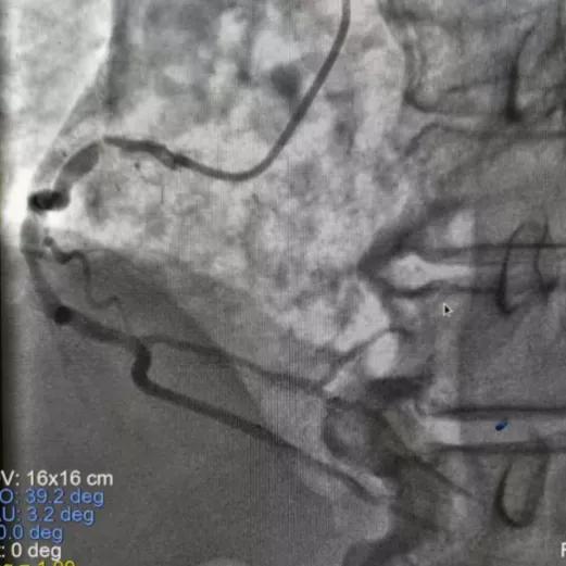 阜阳市妇女儿童医院胸痛中心成功救治 83 岁高龄急性心肌梗死患者