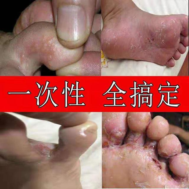 脚气能治好吗 治脚气的药那种管用 河南热线