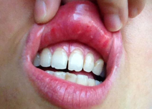 嘴唇是健康的“信灯号”，6种嘴唇标志，暗示6种身体问题，别大意