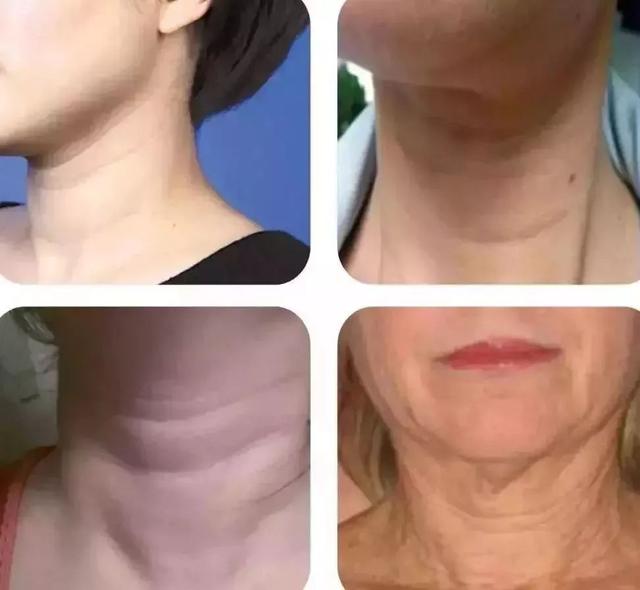 颈纹多少钱(做颈纹手术多少钱)