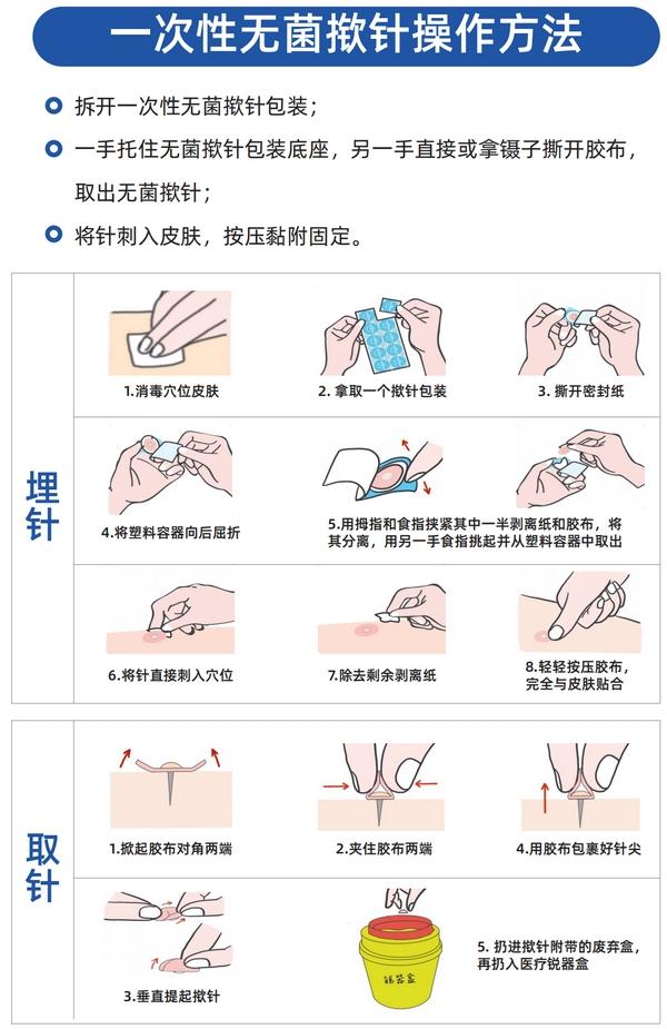 埋针费用(输液埋针一个多少钱)