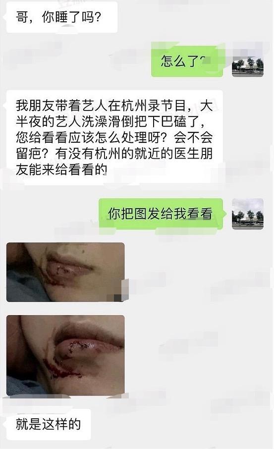 范丞丞洗澡跌倒破相，嘴唇下方出现明显伤痕