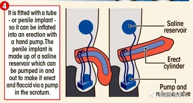 英国老哥感染后〇〇脱落，医生给他在手臂上种了个新的… 这都行？