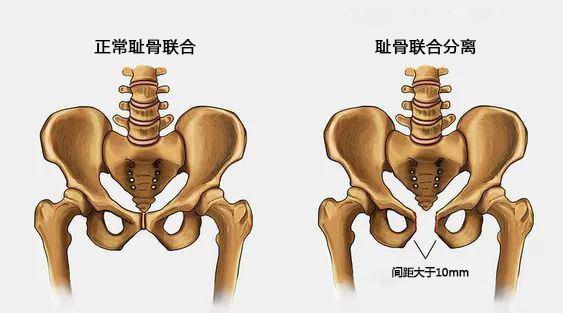 怎么减轻孕期的耻骨分离疼痛