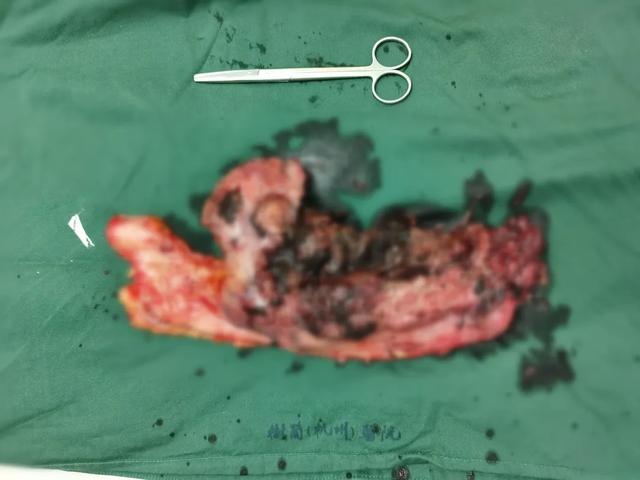 15 cm 肿瘤撑「饱」胃 叶再元教授四小时妙手摘除