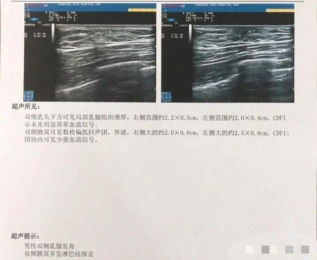 健身|26岁小伙健身3个月乳房发育 乳房再度发育尴尬