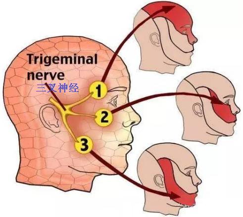 双侧<!--HAODF:8:sanchashenjingtong--><!--HAODF:8:sanchashenjingtong-->三叉神经痛<!--HAODF:/8:sanchashenjingtong--><!--HAODF:/8:sanchashenjingtong-->，微血管减压显良效