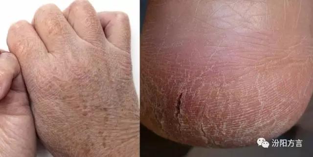 皴是什么意思(婴儿皴皮是什么意思)