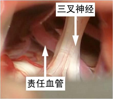 双侧<!--HAODF:8:sanchashenjingtong--><!--HAODF:8:sanchashenjingtong-->三叉神经痛<!--HAODF:/8:sanchashenjingtong--><!--HAODF:/8:sanchashenjingtong-->，微血管减压显良效