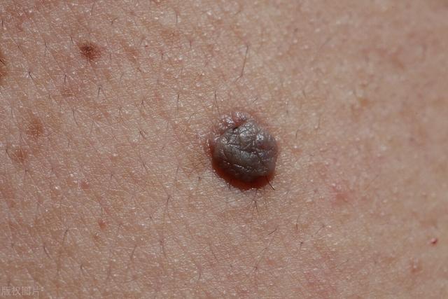 How long does imiquimod cream last for warts? - iMedia