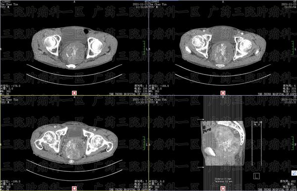 how-long-can-you-live-with-advanced-lung-cancer-imedia