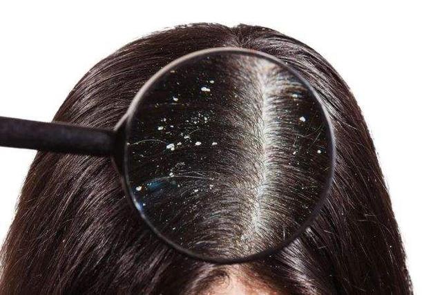 Why do dandruff keep growing when you don't do anything? - iMedia