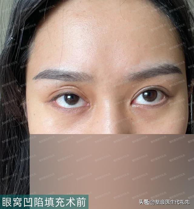 Sunken eye sockets look old and want to fill up?You must know these