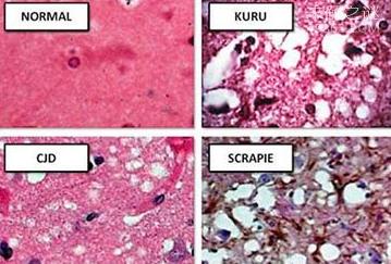 Kuru Disease - IMedia