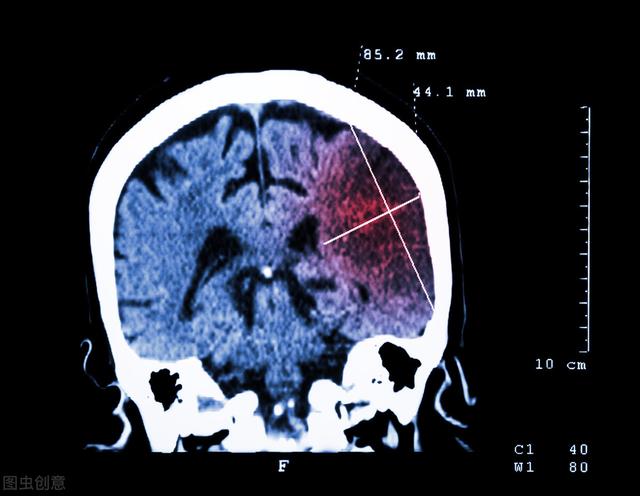 the-sequelae-of-cerebral-infarction-are-difficult-to-treat-and-there