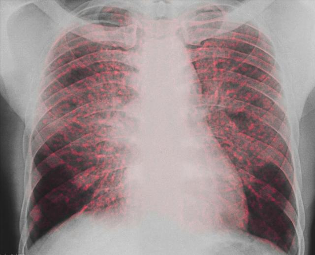 Can lung nodules cancerous?Doctor reminds these types of people