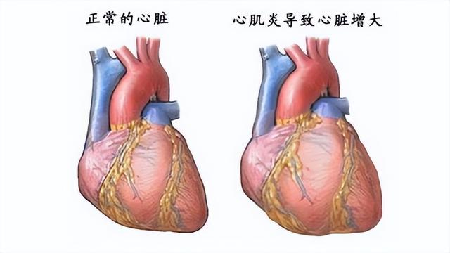 popular-science-questions-and-answers-about-dilated-cardiomyopathy-4