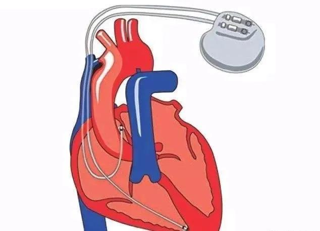 can-i-do-an-mri-with-a-pacemaker-imedia