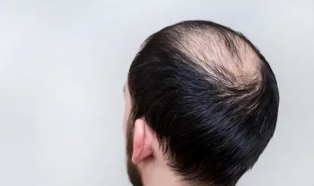 How is seborrheic alopecia treated?In this way, the purpose of ...