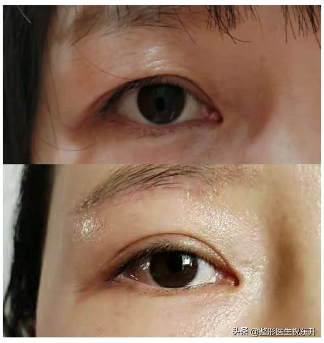Take a look at the indications of "eyebrow lifting, double eyelid