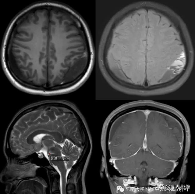 MRI manifestations of hypotension syndrome - iMedia