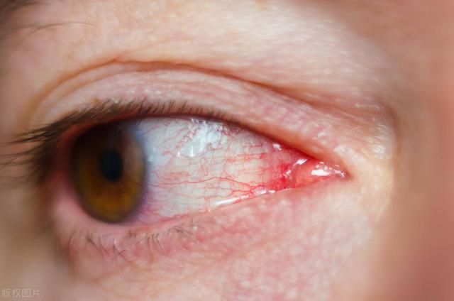 Can catarrhal conjunctivitis heal on its own? How to treat it? - iMedia