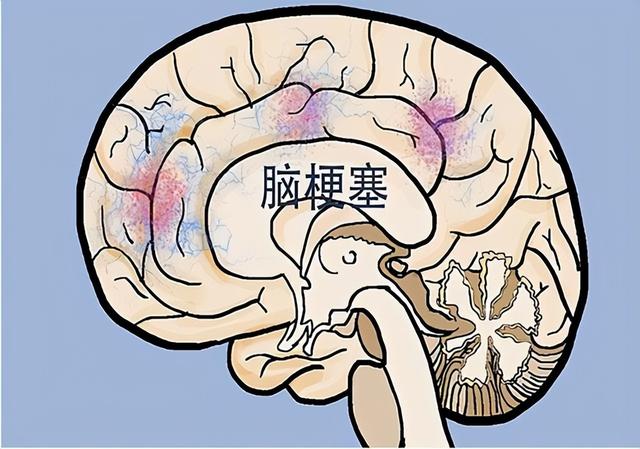 What Are The Symptoms Of Insufficient Blood Supply To The Brain If You 