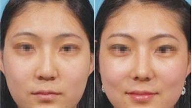 山根低怎么补救