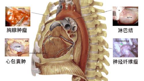 纵膈肿瘤10篇