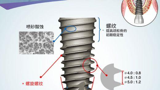 OSSTEM(奥齿泰)系统短种植体在后牙区骨高度不足病例中修复的临床效果