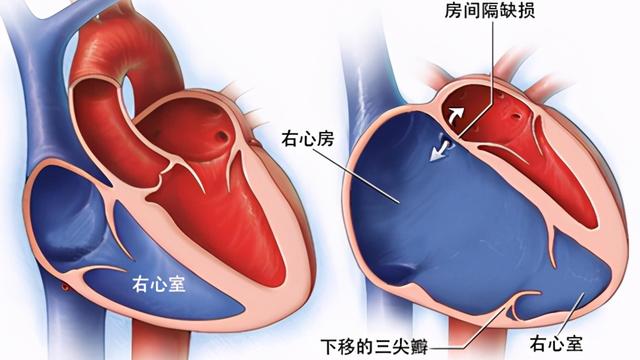 新生儿心脏三尖瓣反流有什么症状