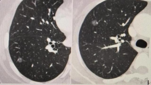 高分辨CT在肺部检查中的应用价值