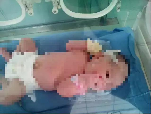 乐山沐川婴儿患Rh血型不合溶血病，市妇幼保健院成功手术救孩儿