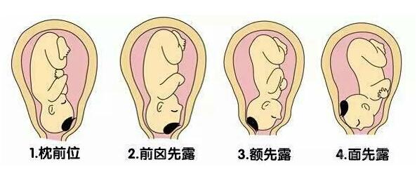 胎位不正怎么办?40年老专家矫正胎位实用