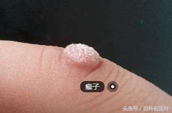 你身上有“瘊子”吗？看中西医是如何让身上“小疙瘩”消失的？