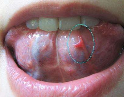 舌头上突然长出大量紫暗色瘀斑，是哪里生病了？跟一种食物有关