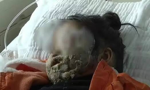 太心痛！“砰”的一声，安顺5岁女童面部被手机爆炸烧伤，恐毁容