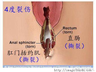 产妇顺产时下面被撕裂,看着就心疼!