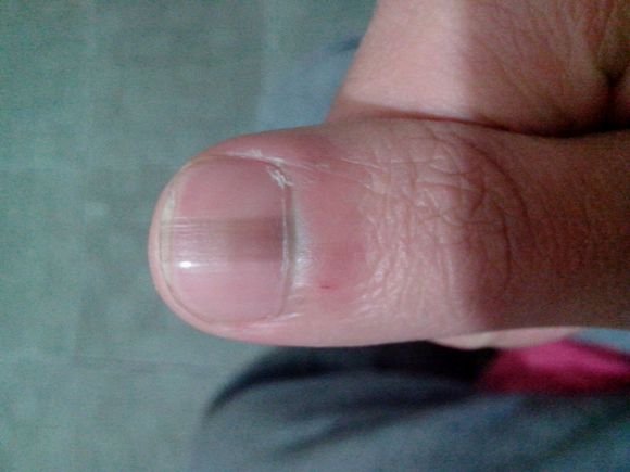 皮肤科医生：指甲上长出这东西，你就要小心黑色素瘤！