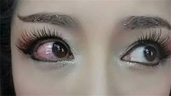 眼白有血丝是什么原因，不只是用眼疲劳