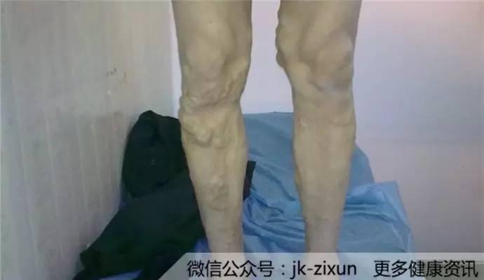 大腿内侧瘙痒别乱挠，小心越挠越严重！